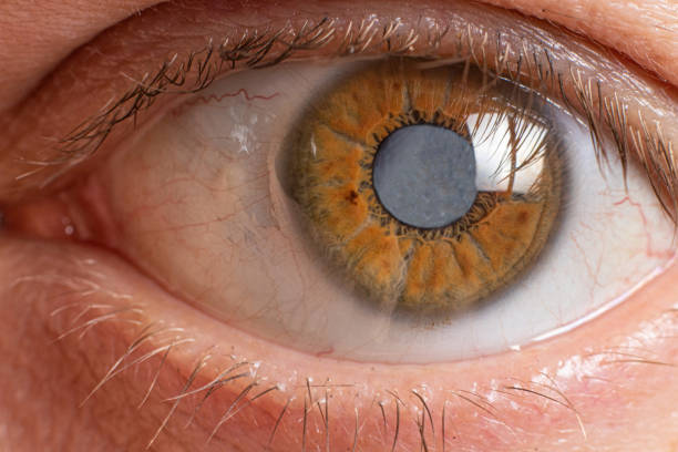 What is the Difference between Glaucoma and Cataracts